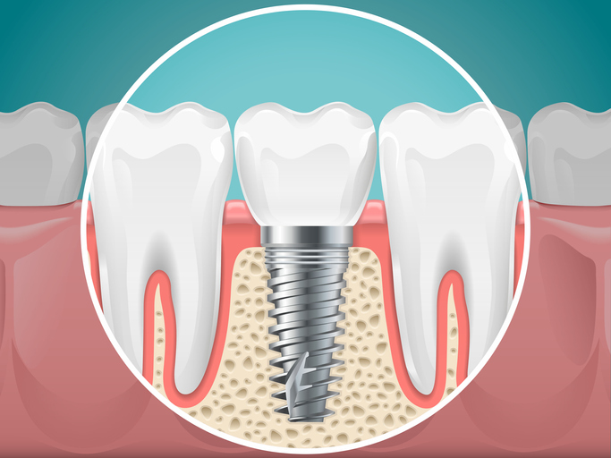 implant metalowy
